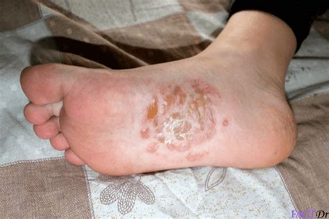 The Agony Of Dyshidrosisdyshidrotic Eczema Tw Blisters And Scabs