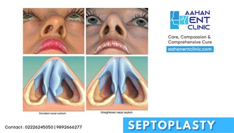 Deviated Nasal Septum Septoplasty What You Need To Know Aahan ENT