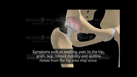 Defective Hip Implant Depuy Hip Replacement Recall Video Youtube