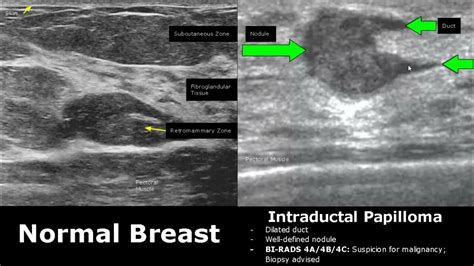 Breast Ultrasound Normal Vs Abnormal Image Appearances Comparison Bi