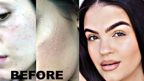 How To Get Rid Of Skin Texture Naturally Naturalskins