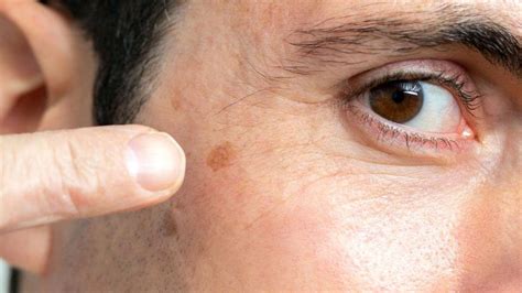 Age Spots Removal Treatment
