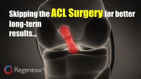 Acl Tear Repair Acl Tear Acl Surgery Ligament Tear