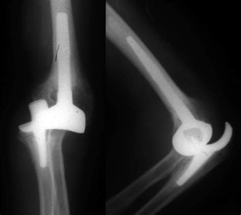 Elbow Replacement For Elective Elbow Conditions Orthopaedics And Trauma