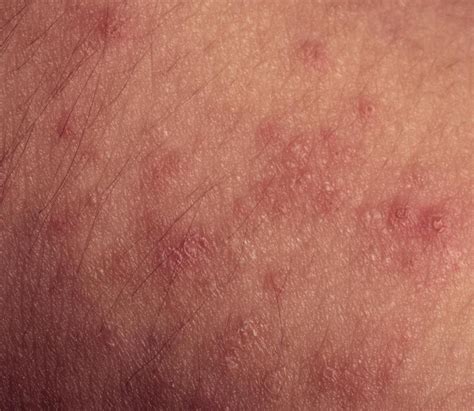 What Are The Common Causes Of A Rash With Pus With Pictures