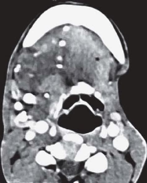 Contrast Ct Images Showing Multiple Phleboliths In Right Submandibular