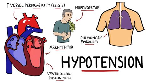 Causes Of Hypotension What Causes Low Blood Pressure With Signs And