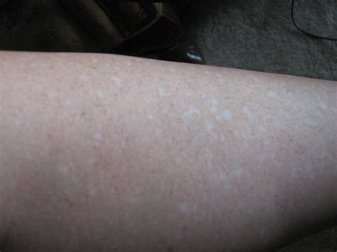 I Have White Scaring On My Legs And Arms From Tinus Funguswill