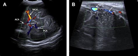 Cranial Ultrasonography Of The Immature Cerebellum Role And