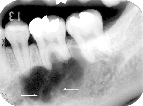 Chp 33 Oral Path Periapicalcentral Radiolucencies Wdistinct