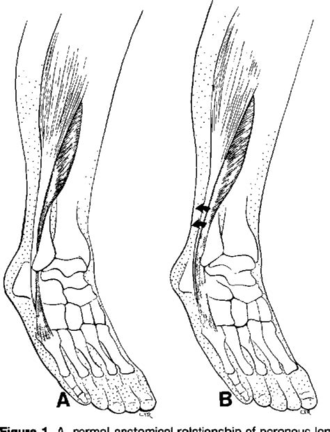 Subluxation Of The Peroneal Tendons Within The Peroneal Tendon Sheath