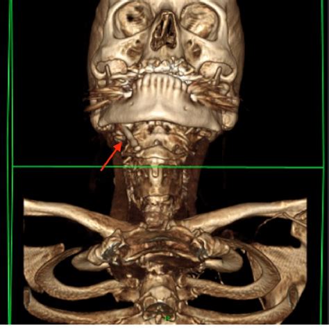Three Dimensional Ct Scan Of The Head And Neck Showing Enlarged
