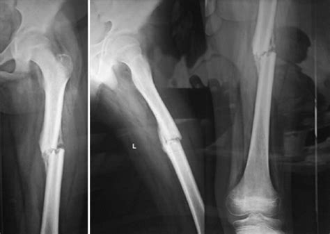 Pre Operative X Ray Of Fracture Shaft Femur Download Scientific Diagram