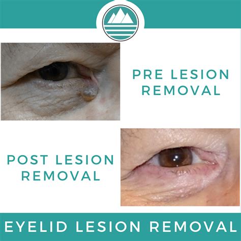 An Eyelid Lesion Is A Pathological Change In The Tissue Around The Eye