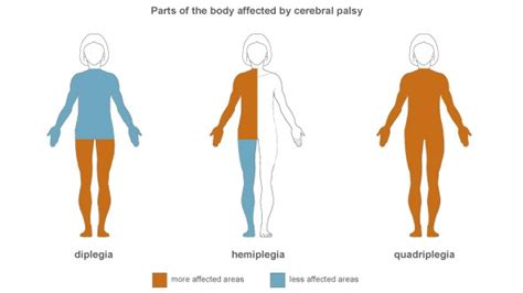 Parts Of The Body Affected By Cerebral Palsy Cerebral Palsy Facts