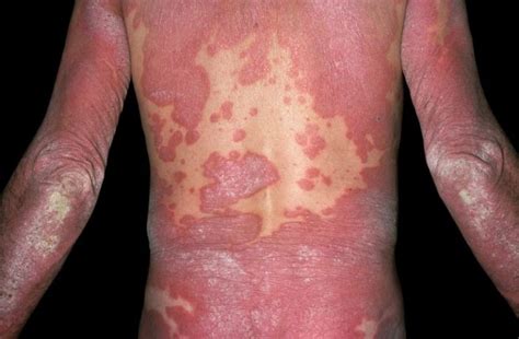 Psoriasis Especially Severe Disease Associated With Increased Risk