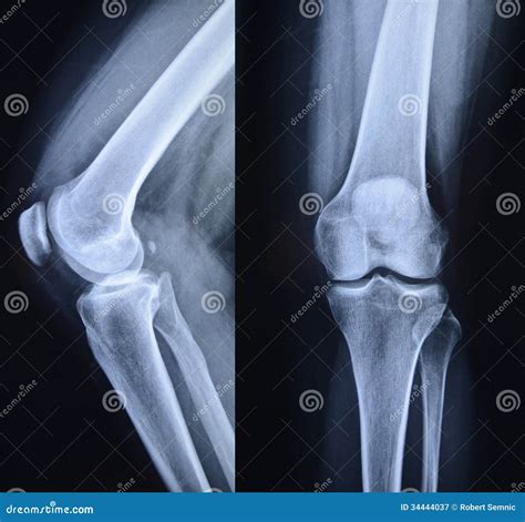 Normal Knee X Ray Royalty Free Stock Photography Image 34444037