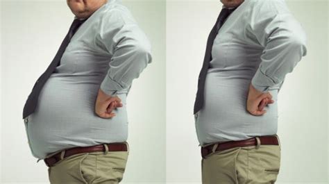 Worlds Most Obese Man Dies After Weight Loss Surgery Ndtv Food