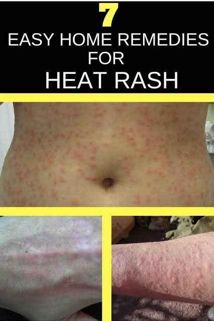 How To Get Rid Of Heat Rash Heat Rash Heat Rash Treatment Heat