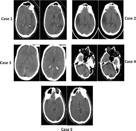 Axial Ct Scan Without Injection Brain Images Cranial Ct Scan Imaging