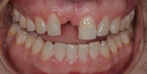 A Missing Front Tooth Stages Of Dental Implant Replacement