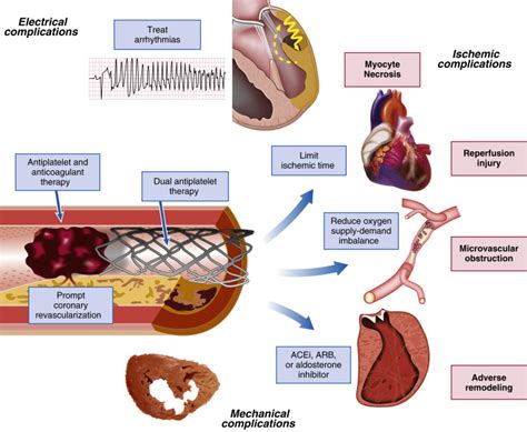 With acute myocardial infarction, very fast and adequate emergency care should be provided, after which the drug treatment is performed as soon as possible. Management Principles in Myocardial Infarction | Thoracic Key