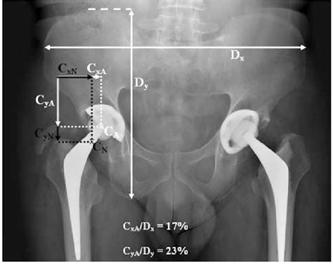 An Ap Radiograph Of The Pelvis Of A Male Patient Shows A Hip