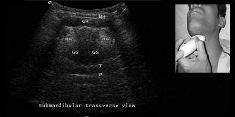 Submandibular Ultrasound