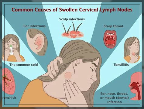 Swollen Cervical Lymph Nodes What Does It Mean Dental Infection The