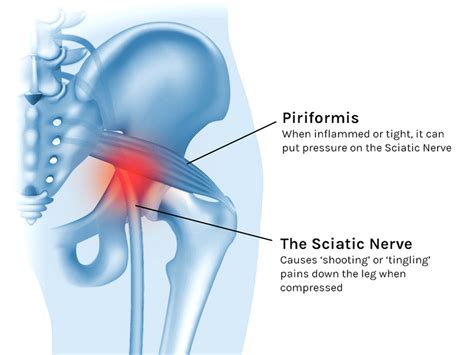 Is Your Piriformis Really To Blame For Your Pain Tom Morrison