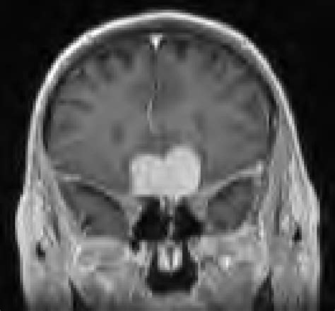 Example Of An Anterior Skull Base Meningioma Removed From Below The
