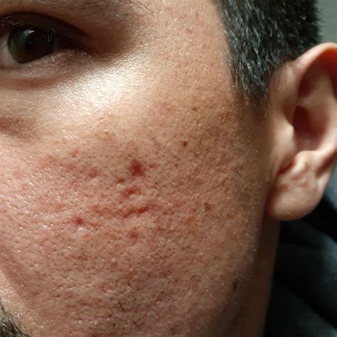 Help Severe Acne Scars Page 2 Scar Treatments Forum