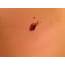 Does This Look Like Melanoma 
