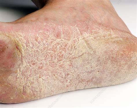 Eczema Of The Foot Stock Image C0238932 Science Photo Library