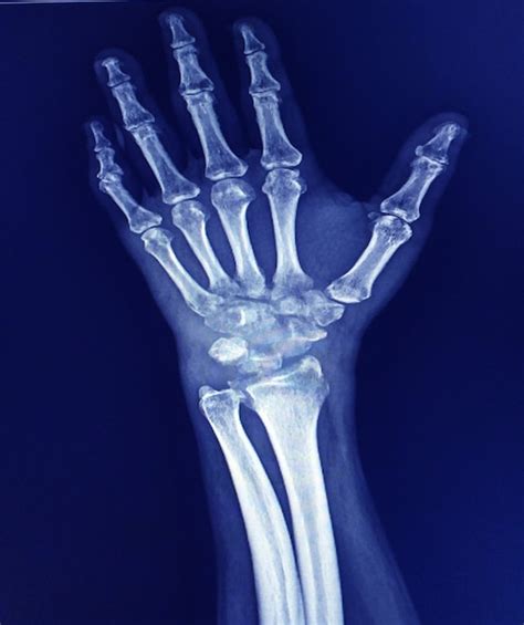 Premium Photo Wrist X Ray Showing Severe Arthritis Of The Wrist Or