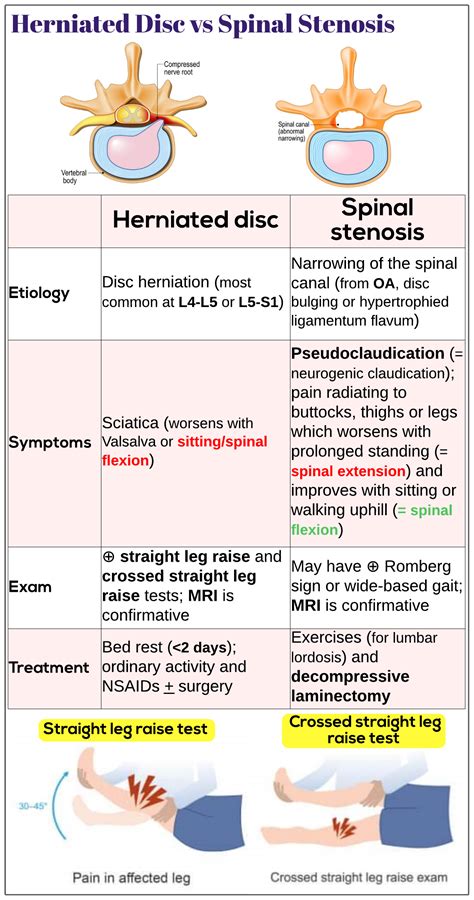 Herniated Disc Vs Spinal Stenosis Medicine Keys For MRCPs
