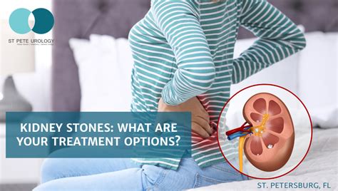 Kidney Stones What Are Your Treatment Options St Pete Urology