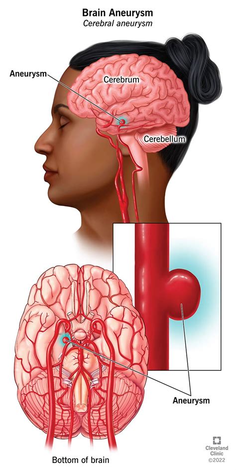 Understanding Aneurysms Causes Symptoms And Treatment Options