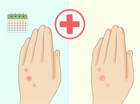 Allergy Trigger How To Treat Your Skin After Bed Bug Bites