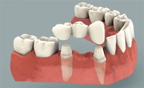 What Are Dental Bridges Dental Bridge Are False Tooth Also Known As A