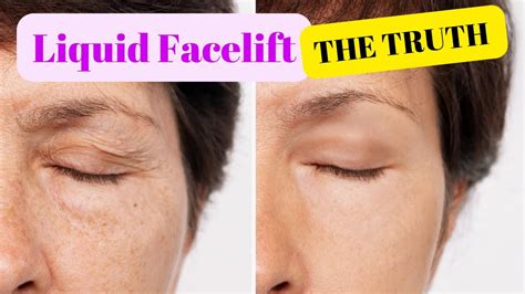 Liquid Facelift Need To Know Facts When Thinking Of A Liquid Facelift Youtube