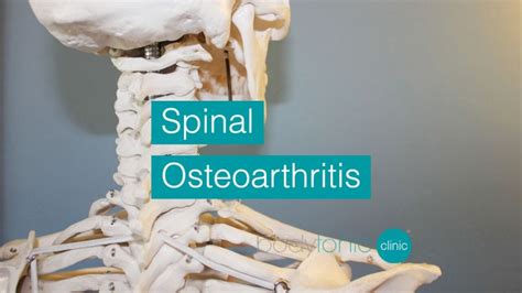 Spinal Osteoarthritis Symptoms Prevention And Treatment Options