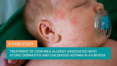 Treatment Of Cow Milk Allergy Associated With Atopic Dermatitis And