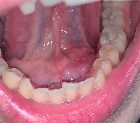 White Sores On Floor Of Mouth