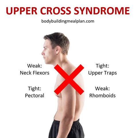 Upper Cross Syndrome Exercises To Correct Your Posture And Alleviate Pain