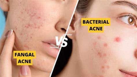 Fungal Acne Vs Bacterial Acne Key Differences And Treatment Approaches