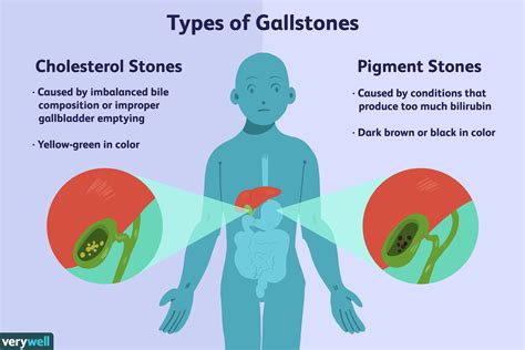 Gallstones Overview And More