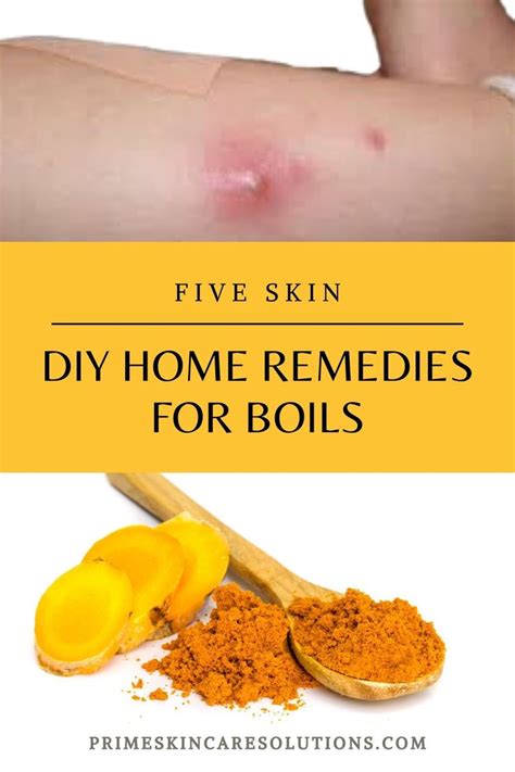 Effective Home Remedies To Get Rid Of Boil Youtube