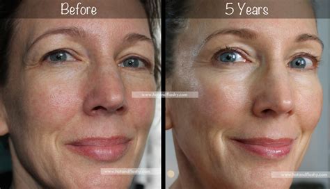 5 year retin a results ~ before and after for wrinkles and anti aging skin care wrinkles anti