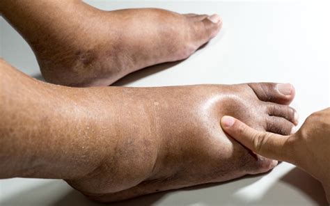 Why Are My Feet Swollen Causes Treatments And Prevention Massage